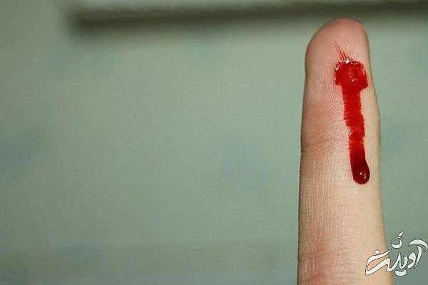 غش کردن با دیدن خون علت فوبیای خون